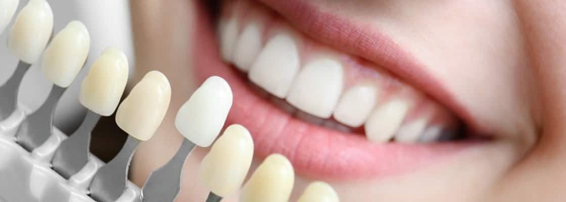 Discover the Top 5 Cosmetic Dentistry Treatments