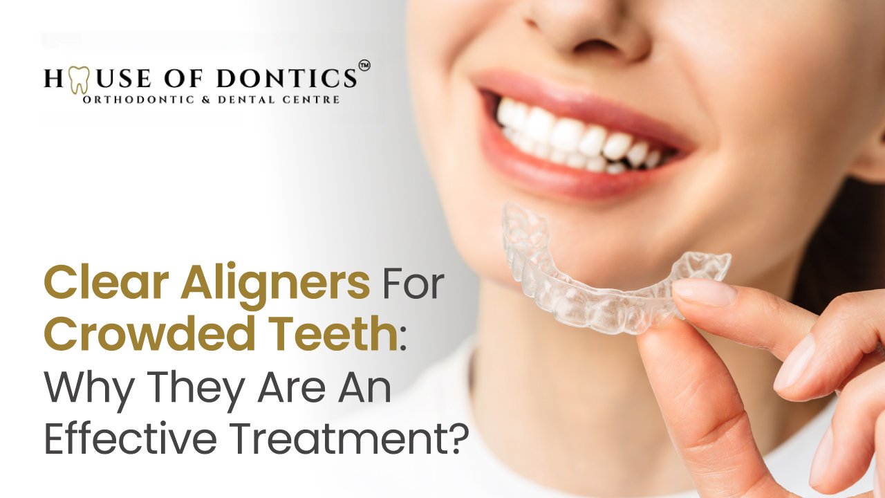 Clear Aligners for Crowded Teeth