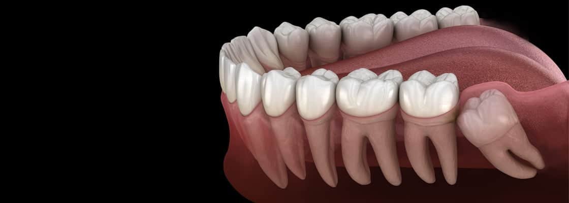 How to Relieve Wisdom Tooth Pain: Tips and Tricks