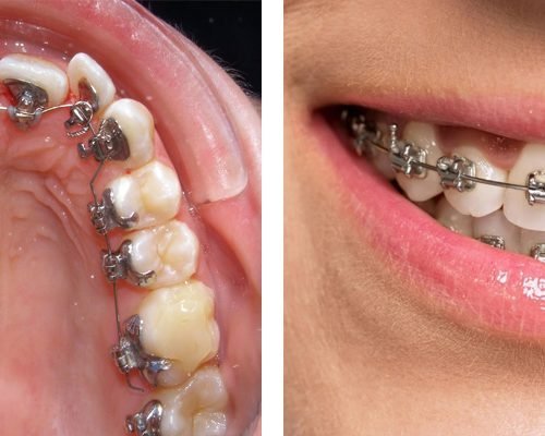 Lingual Braces vs. Traditional Braces: Comparing the Differences