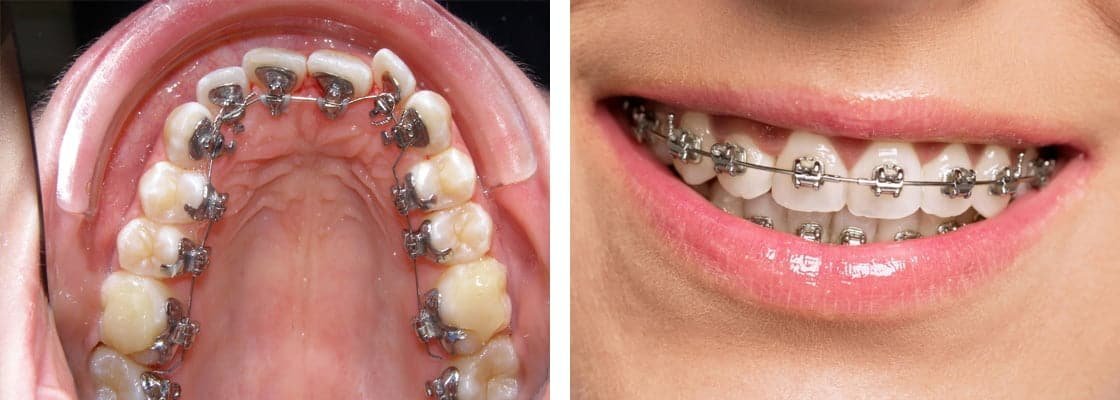 Lingual Braces vs. Traditional Braces: Comparing the Differences