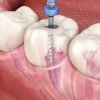 Root Canal Tratment 3