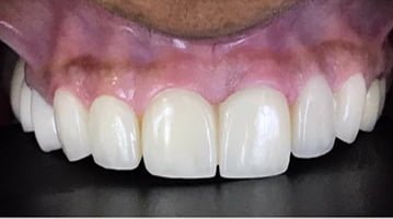 GAP-CLOSURE-WITH-CROWNS-After-1