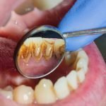 best-deep-cleaning-treatment-in-ahmedabad