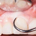 deep-cleaning-treatment-in-ahmedabad