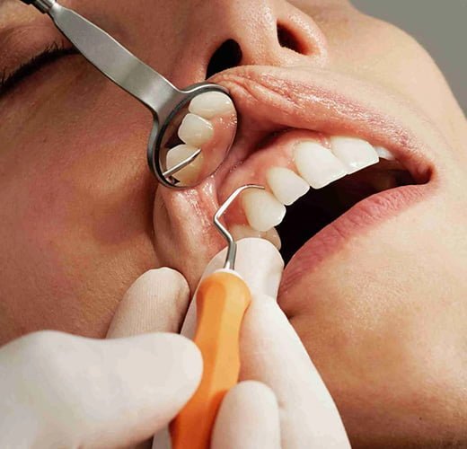 deep-cleaning-treatment-in-gujarat