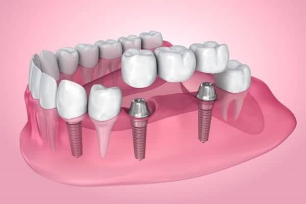 dental implants with bridges