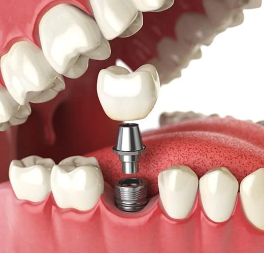 Dental Implants Treatment Ahmedabad