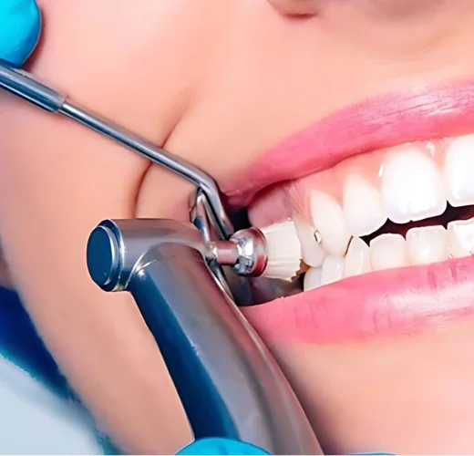 Fluoride Treatment in Ahmedabad