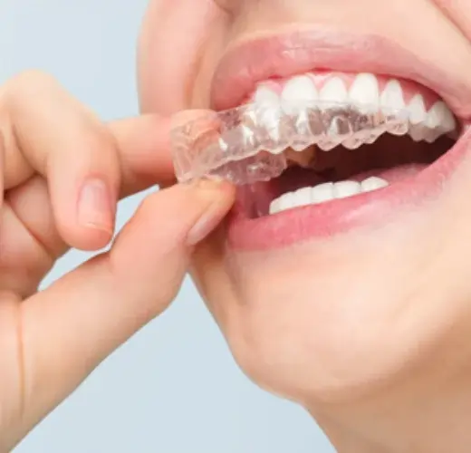 Invisible Clear Aligners Cost in Ahmedabad