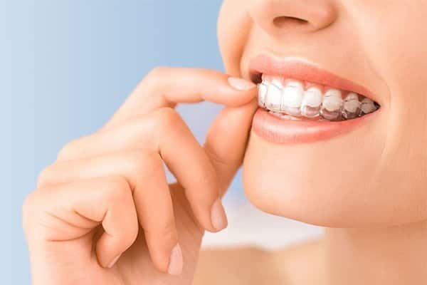 Clear aligners orthodontics treatments